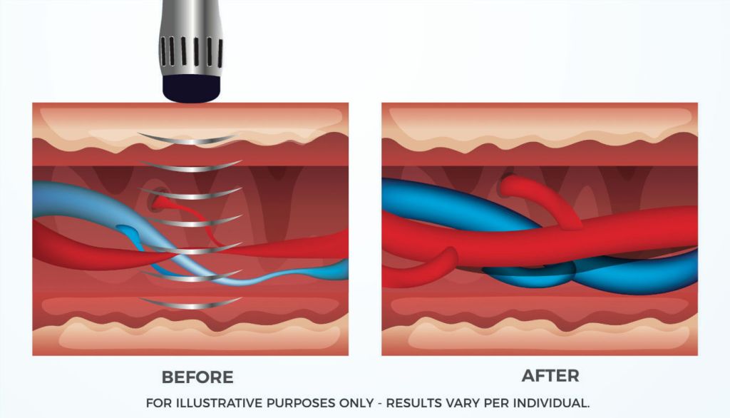 shock-wave-therapy-visual-1024x586